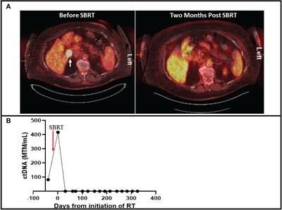 Case Report: Stereotactic body radiation treatment for immunotherapy escaped oligometastatic progression in cutaneous melanoma and merkel cell carcinoma